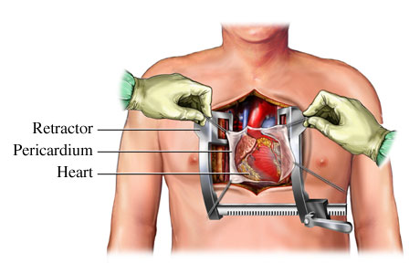 open heart surgery incision diagram