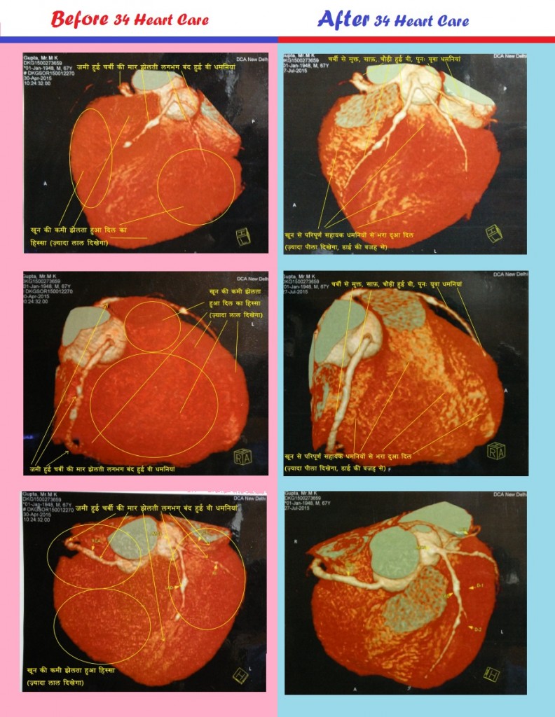 Patient CT Angiography Report Before & After 34 Heart Care Treatment